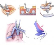 肋软骨隆鼻 一次手术解决很多次的繁琐化妆
