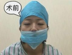 兰州黛美尔和兰州亚韩鼻整形哪家好 歪鼻矫正有哪些优势