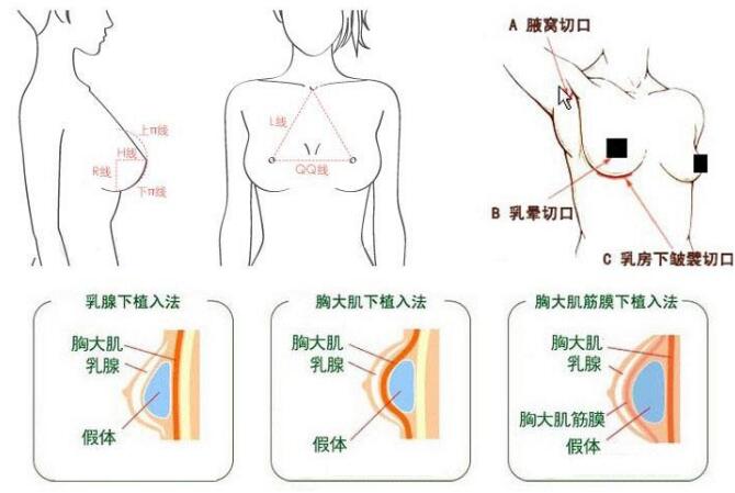 决定隆胸假体尺寸的因素除了胸廓和皮肤张力