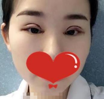 南京鼓楼医院整形科割双眼皮怎么样？术后果图分享给你们