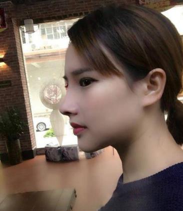 长沙美莱玻尿酸丰下巴术后2个月果照，注射技术真的很好