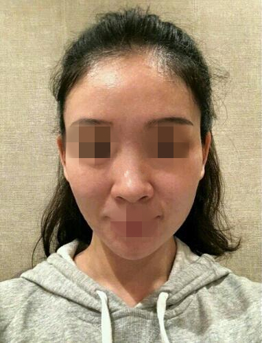 温州艺星医学美容医院自体脂肪填充面部果反馈，饱满自然少女脸