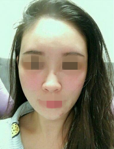 温州艺星医学美容医院自体脂肪填充面部果反馈，饱满自然少女脸