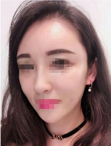 温州艺星医学美容医院自体脂肪填充面部果反馈，饱满自然少女脸