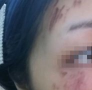 长沙宁乡县人民医院美容科去疤痕怎么样？恢复果图一览