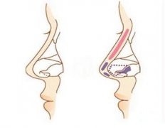 假体隆鼻取出后鼻子会更塌吗