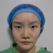 杭州时光范眉清割双眼皮怎么样？真人案例术后三个月果展示