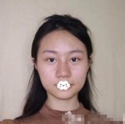 杭州117医院整形美容中心注射瘦脸怎么样？案例术后果展示