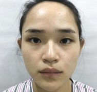 上海华美医疗美容医院硅胶隆鼻怎么样？先看看我的案例在说果吧！