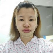 深圳市龙岗中心医院整形科怎么样？整合了改脸型成功案例及价格清单参考