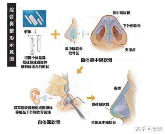 综合整形鼻子的价格是多少?鼻子综合整形多少钱?