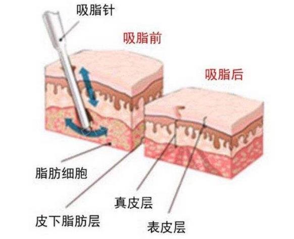 水动力吸脂会不会留下疤痕？