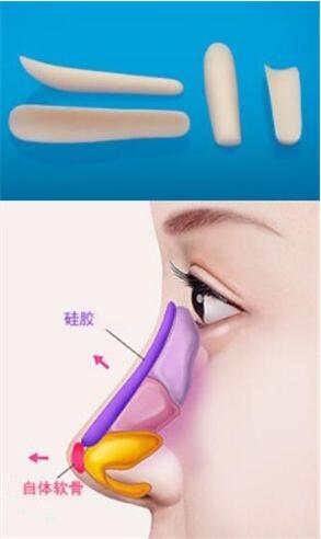 隆鼻假体取出后有后遗症吗?假体取出后鼻子会更塌吗?