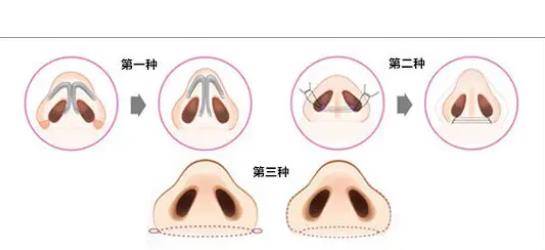 鼻翼缩小手术有哪些常见方法?