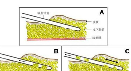 什么是大腿环吸