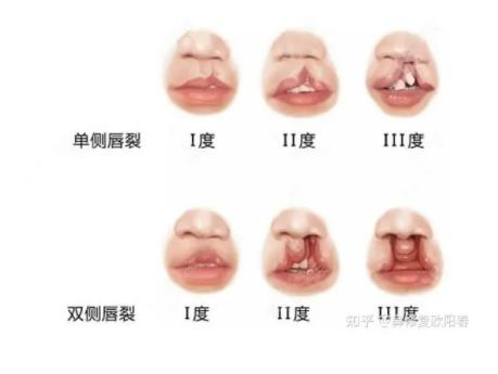 调节唇腭裂一般有哪些方法?哪种方法果好?