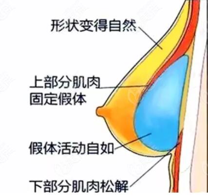 假体丰胸可以不取假体吗?假体丰胸能坚持多久?