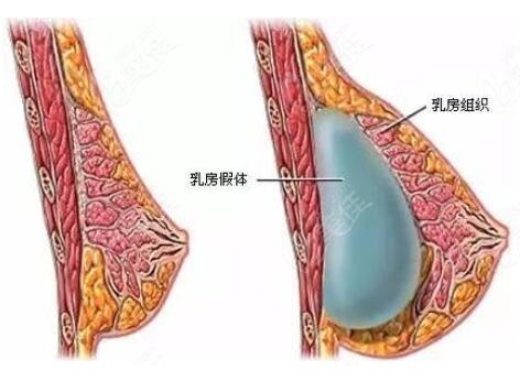 隆胸假体取出多少钱?隆胸假体取出后的护理怎么做?