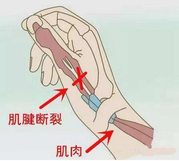 手指屈曲畸形有哪些表现?手指屈曲畸形的治疗应注意的有哪些?