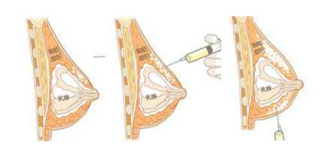 注射隆胸手术价格_多少钱?