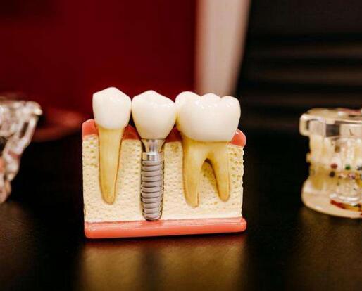 种植牙的过程要花多长时间?
