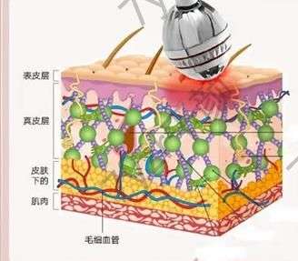 射频紧肤除皱有哪些优势，要多少钱?