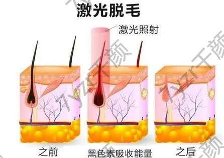 光子脱毛会影响身体健康吗，有哪些注意事项