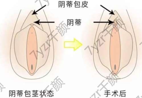 小阴唇肥大要不要做手术？