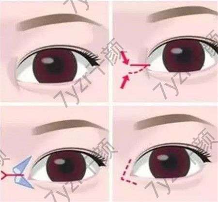如何提高开眼角手术的成功率?