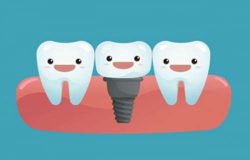 牙科医院种植牙优势主要有哪些？