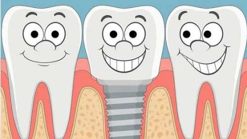 种植牙好不好？专家解析种植牙的优缺点