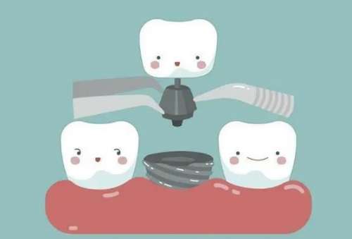 种植牙后如何护理？详细解答术后恢复期的常见问题