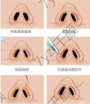鼻翼缩小术的手术方法有哪些?