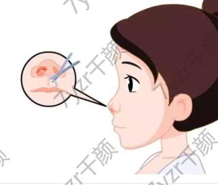 鼻翼缩小手术常用的方法有哪些