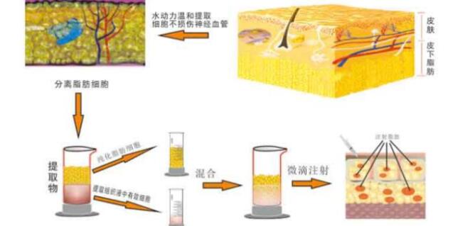 面部脂肪填充的基本原理