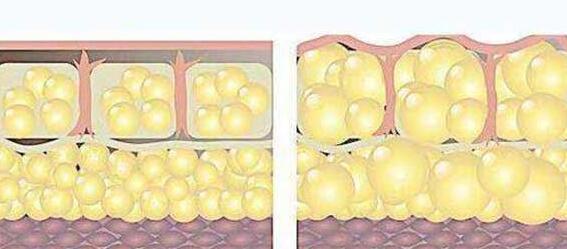 关于自体脂肪填充的一些疑问解答