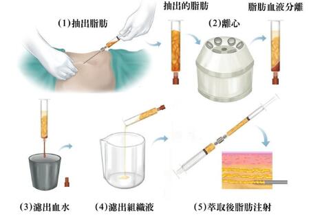 自体脂肪填充术后如何护理?