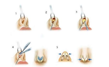 什么是膨体隆鼻手术?