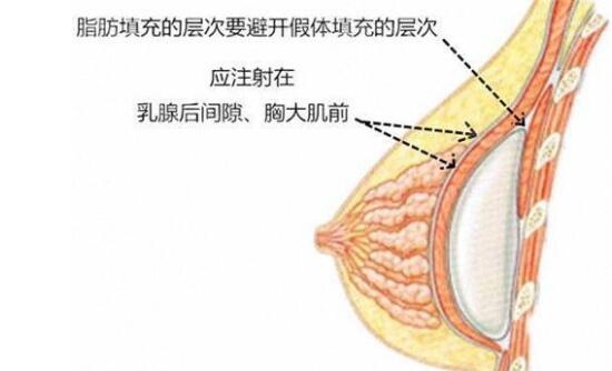 做妙桃假体隆胸务必注意的事项：