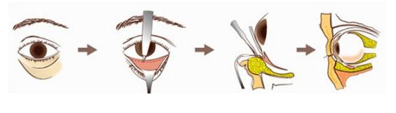 切开祛眼袋