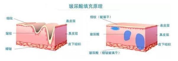 注射玻尿酸祛皱是否有风险呢？有哪些风险？