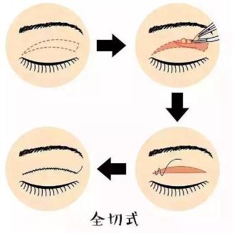 全切双眼皮术后疤痕增生的时长