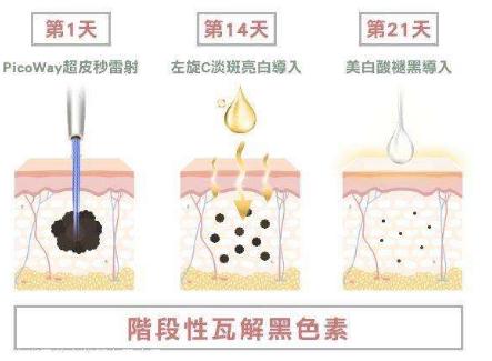 激光祛斑的的原理介绍