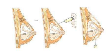 自体脂肪移植乳房手术原理