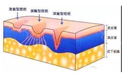 点阵激光祛痘原理