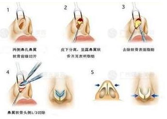 鼻头缩小手术的果可以维持多久?