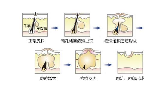 脸上青春痘留下的痘印怎么去掉?