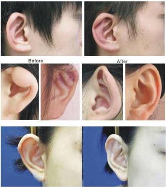 耳朵畸形怎么办?可以做矫正吗?