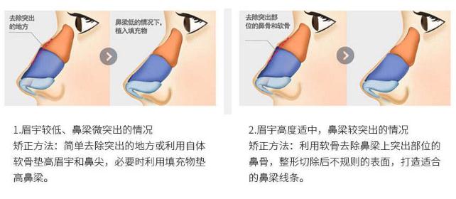 尽管驼峰鼻矫正不是什么大手术，但是还是得说一说后遗症问题！