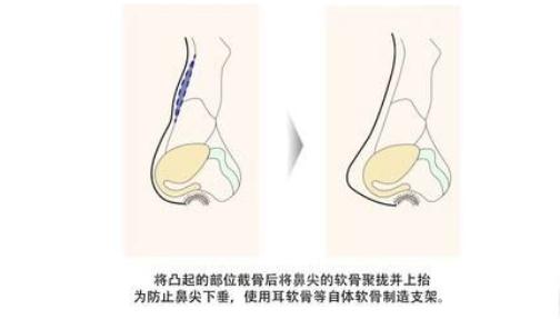 尽管驼峰鼻矫正不是什么大手术，但是还是得说一说后遗症问题！